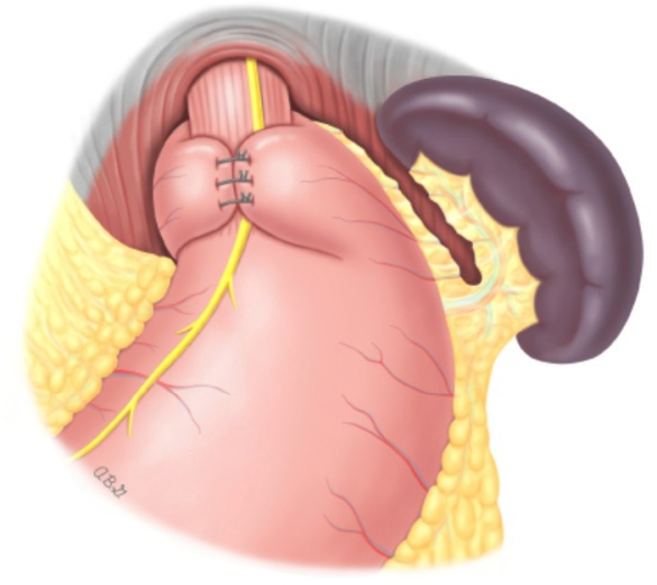 Hiatal Hernia